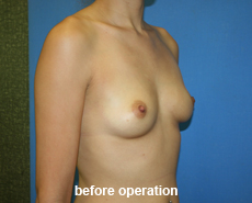 plastic-surgery-breast-augmentation